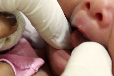 notícia: Hospital Materno Infantil destaca a importância do Teste da Linguinha em recém-nascidos