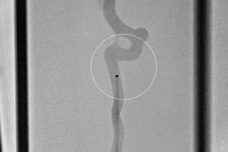 Hospital Abelardo Santo realiza cirurgia de alta complexidade para remover aneurisma cerebral em paciente.
 <div class='credito_fotos'>Foto: Pedro Guerreiro / Ag. Pará   |   <a href='/midias/2021/originais/8612_8166f201-4f29-0b09-70f4-28034d2e439b.jpg' download><i class='fa-solid fa-download'></i> Download</a></div>